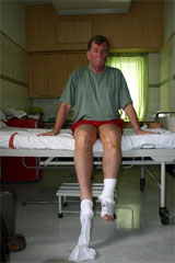 Total Knee Replacement FAQs